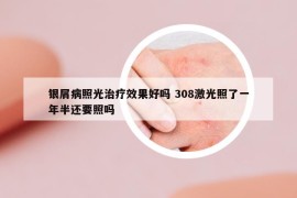 银屑病照光治疗效果好吗 308激光照了一年半还要照吗
