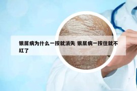 银屑病为什么一按就消失 银屑病一按住就不红了