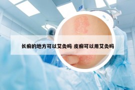 长癣的地方可以艾灸吗 皮癣可以用艾灸吗