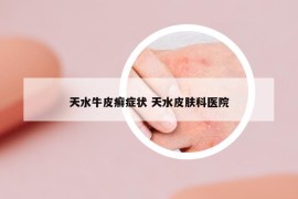 天水牛皮癣症状 天水皮肤科医院