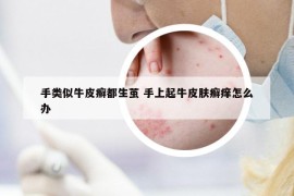 手类似牛皮癣都生茧 手上起牛皮肤癣痒怎么办