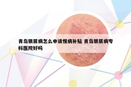 青岛银屑病怎么申请慢病补贴 青岛银屑病专科医院好吗