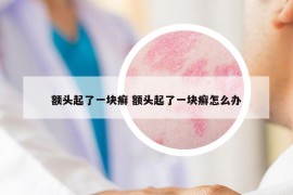 额头起了一块癣 额头起了一块癣怎么办