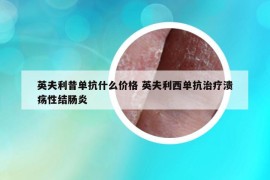 英夫利昔单抗什么价格 英夫利西单抗治疗溃疡性结肠炎