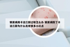 银屑病用卡泊三醇过敏怎么办 银屑病擦了卡泊三醇为什么出现很多小红点