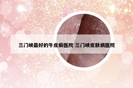 三门峡最好的牛皮癣医院 三门峡皮肤病医院
