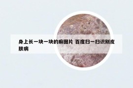 身上长一块一块的癣图片 百度扫一扫识别皮肤病