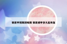 银屑甲初期到晚期 银屑病甲多久能恢复
