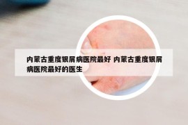 内蒙古重度银屑病医院最好 内蒙古重度银屑病医院最好的医生