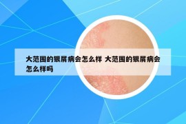 大范围的银屑病会怎么样 大范围的银屑病会怎么样吗