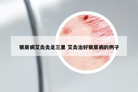 银屑病艾灸灸足三里 艾灸治好银屑病的例子
