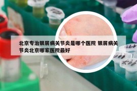 北京专治银屑病关节炎是哪个医院 银屑病关节炎北京哪家医院最好