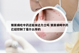 银屑病吃中药还能抹达力士吗 银屑病喝中药已经控制了是什么样的