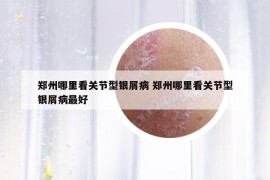 郑州哪里看关节型银屑病 郑州哪里看关节型银屑病最好