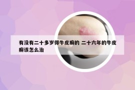 有没有二十多岁得牛皮癣的 二十六年的牛皮癣该怎么治