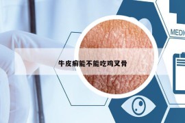 牛皮癣能不能吃鸡叉骨