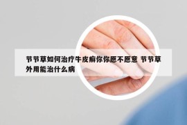 节节草如何治疗牛皮癣你你愿不愿意 节节草外用能治什么病