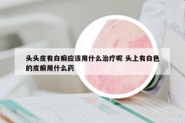 头头皮有白癣应该用什么治疗呢 头上有白色的皮癣用什么药