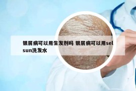 银屑病可以用生发剂吗 银屑病可以用selsun洗发水