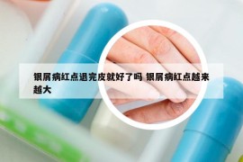银屑病红点退完皮就好了吗 银屑病红点越来越大
