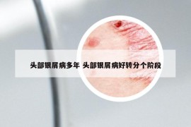 头部银屑病多年 头部银屑病好转分个阶段
