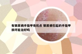 有银屑病手指甲有坑点 银屑病引起的手指甲损坏能治好吗