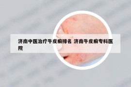 济南中医治疗牛皮癣排名 济南牛皮癣专科医院