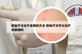刺血疗法治牛皮癣的方法 刺血疗法可以治疗皮肤病吗