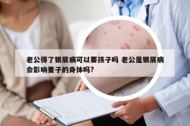 老公得了银屑病可以要孩子吗 老公是银屑病会影响妻子的身体吗?