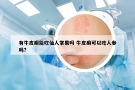 有牛皮癣能吃仙人掌果吗 牛皮癣可以吃人参吗?