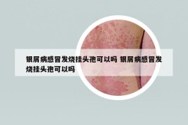 银屑病感冒发烧挂头孢可以吗 银屑病感冒发烧挂头孢可以吗