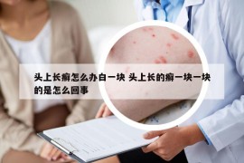 头上长癣怎么办白一块 头上长的癣一块一块的是怎么回事