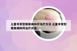 儿童寻常型银屑病如何治疗方法 儿童寻常型银屑病如何治疗方法