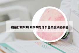 病菌行银屑病 银屑病是什么菌类感染的病菌