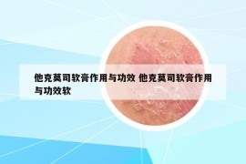 他克莫司软膏作用与功效 他克莫司软膏作用与功效软