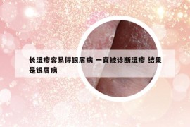 长湿疹容易得银屑病 一直被诊断湿疹 结果是银屑病