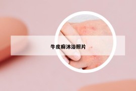 牛皮癣沐浴照片