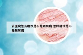 去医院怎么确诊是不是银屑病 怎样确诊是不是银屑病