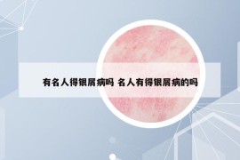 有名人得银屑病吗 名人有得银屑病的吗