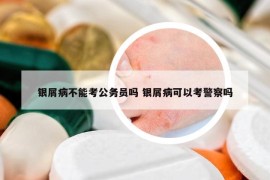 银屑病不能考公务员吗 银屑病可以考警察吗