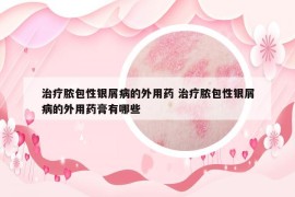 治疗脓包性银屑病的外用药 治疗脓包性银屑病的外用药膏有哪些