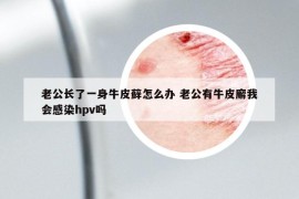 老公长了一身牛皮藓怎么办 老公有牛皮廨我会感染hpv吗
