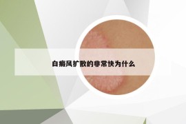 白癜风扩散的非常快为什么