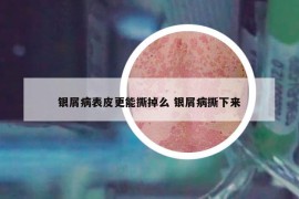 银屑病表皮更能撕掉么 银屑病撕下来
