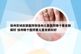 徐州京城皮肤医院和徐州儿童医院哪个看皮肤癣好 徐州哪个医院看儿童皮肤科好
