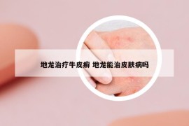 地龙治疗牛皮癣 地龙能治皮肤病吗