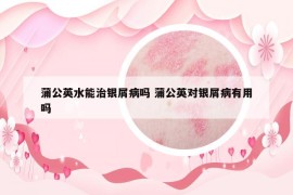 蒲公英水能治银屑病吗 蒲公英对银屑病有用吗