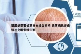 银屑病需要长期补充维生素吗 银屑病患者应该补充哪些维生素