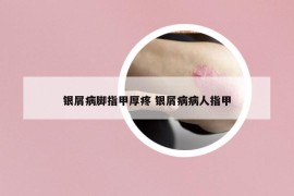 银屑病脚指甲厚疼 银屑病病人指甲