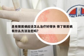 患有银屑病应该怎么治疗好得快 得了银屑病有什么方法治愈吗?